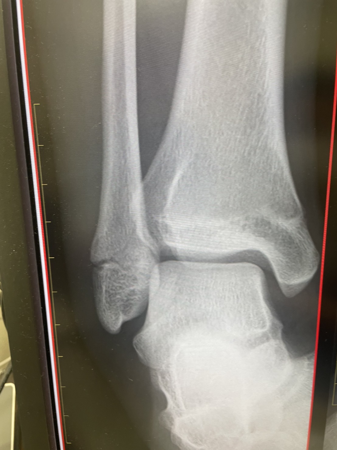 奇跡じゃなく“戦略”で作った中学生バスケ選手の骨折からのリアル記録